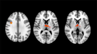 Multimodal MRI Longitudinal Assessment of White and Gray Matter in Different SPG Types of Hereditary Spastic Paraparesis